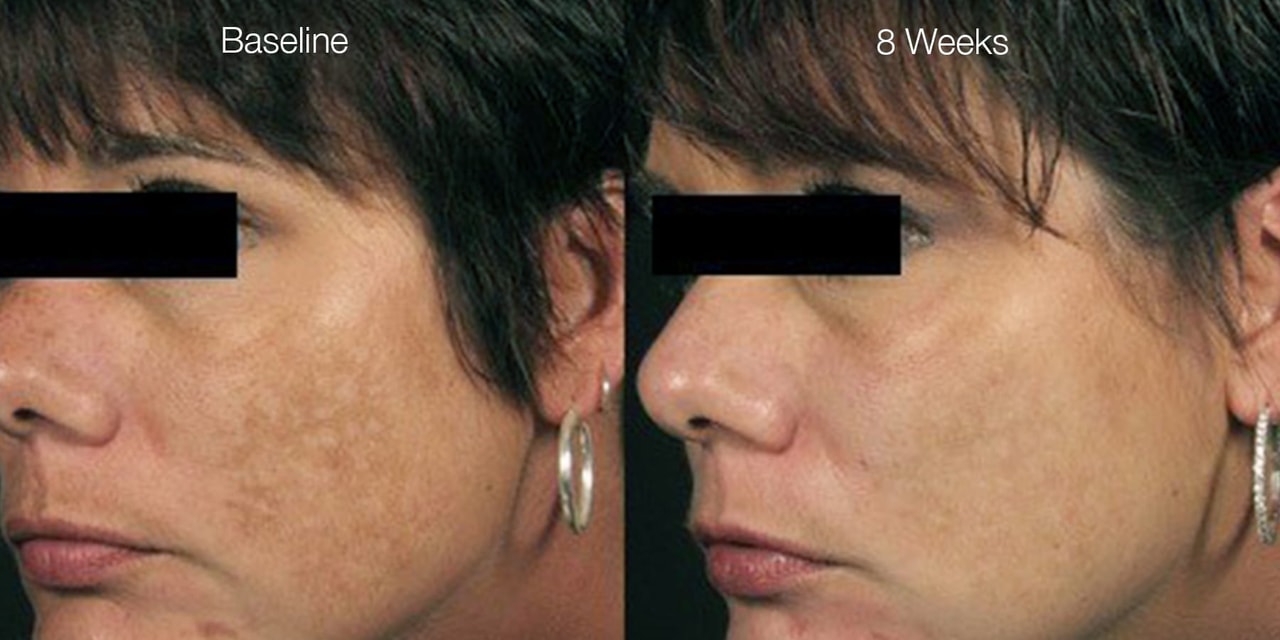 Diamond Glow before and after 2