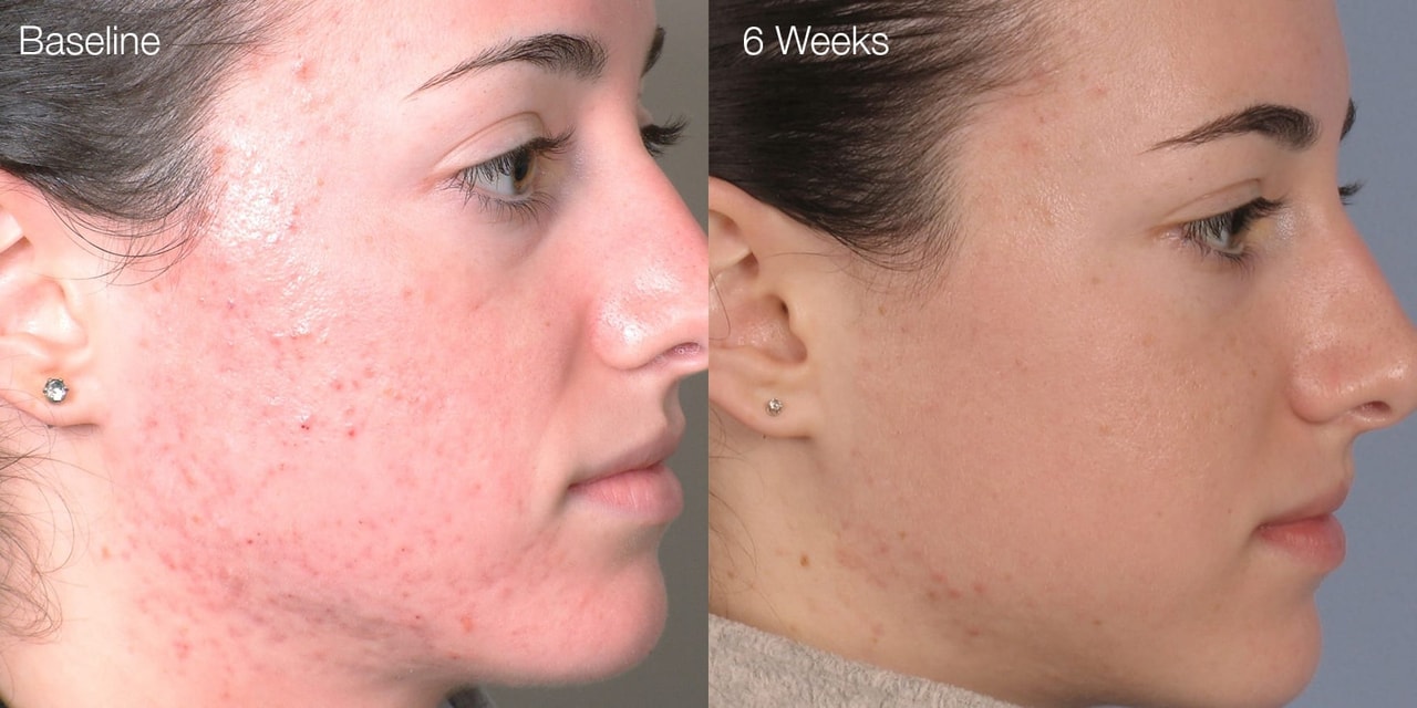 Diamond Glow before and after 1