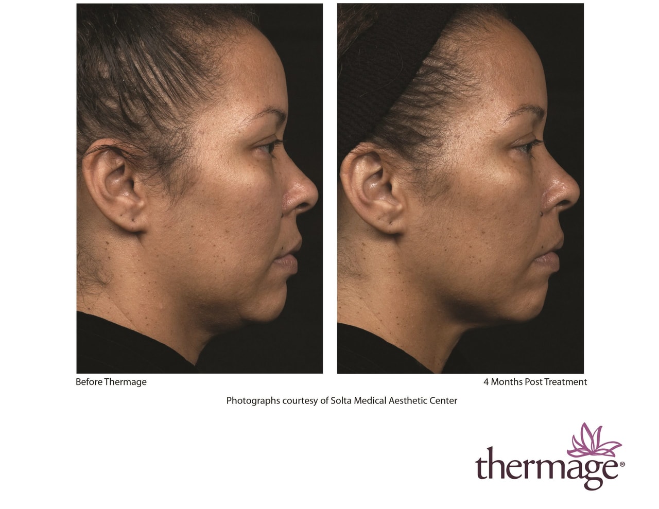 NEW Thermage FLX® Face before and after 4