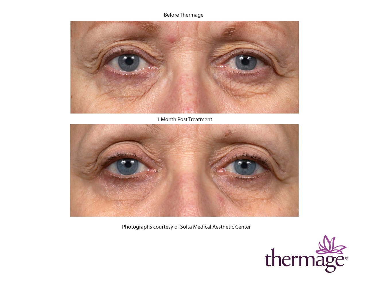 NEW Thermage FLX® Face before and after 3