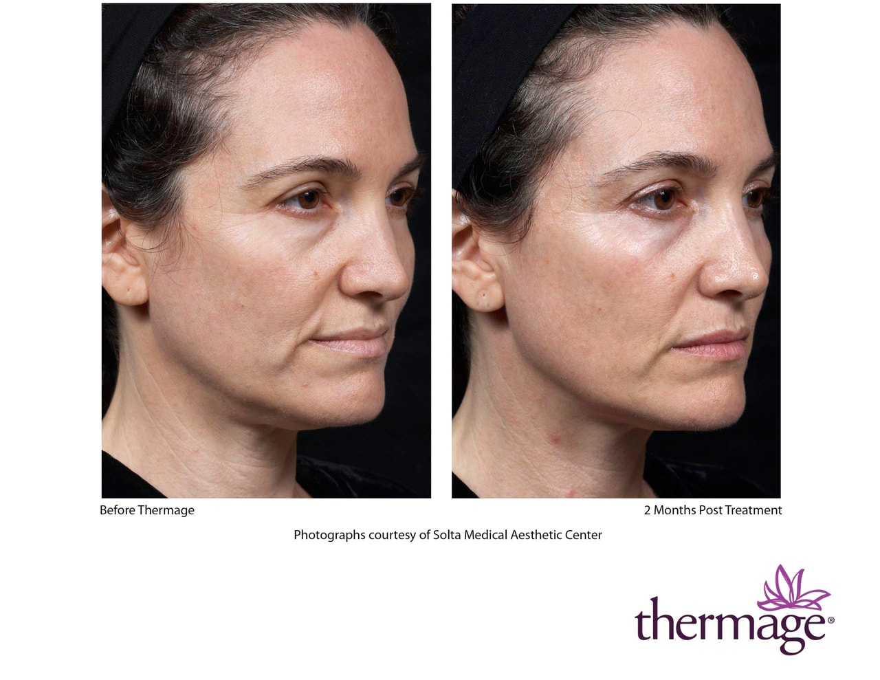 NEW Thermage FLX® Face before and after 5