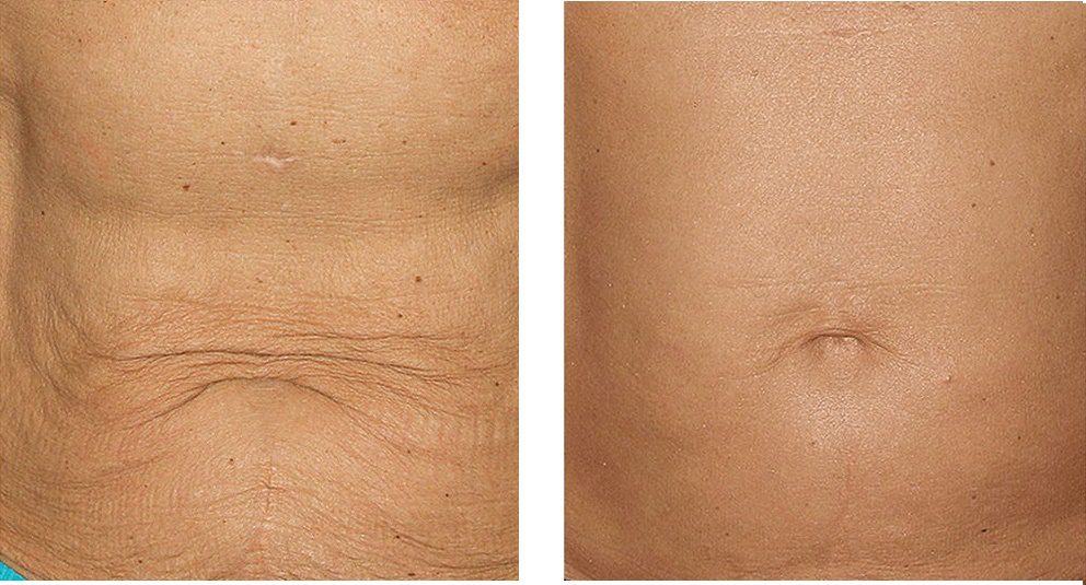 Thermage FLX® Body before and after 5