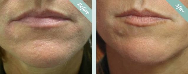 SmartXIDE Co2 Laser Resurfacing before and after 1