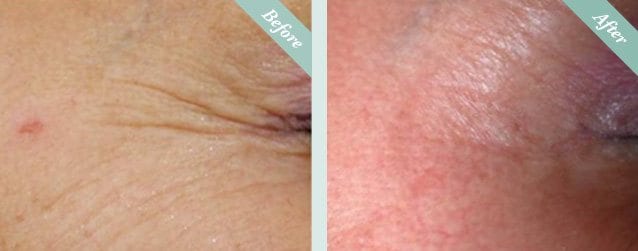 SmartXIDE Co2 Laser Resurfacing before and after 2