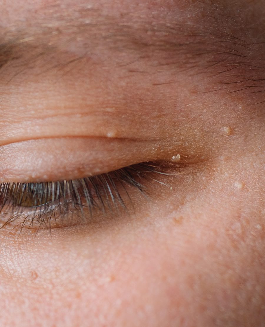 Benign skin lesions suitable for cryotherapy at Maison Restorative