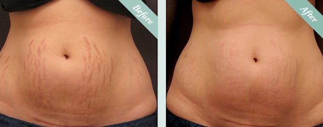 Fraxel Skin Resurfacing before and after 1