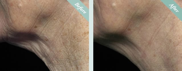 Fraxel Skin Resurfacing before and after 2