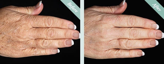Fraxel Skin Resurfacing before and after 3