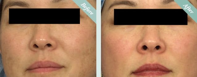 Fraxel Skin Resurfacing before and after 4
