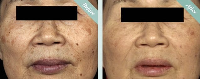 Fraxel Skin Resurfacing before and after 5