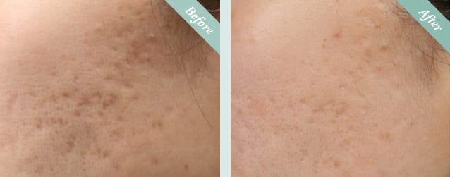 INTRAcel Radiofrequency Microneedling Before & After 2