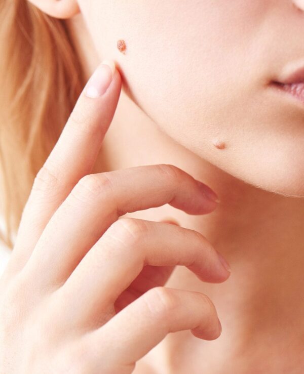 Mole mapping, dermoscopic skin examination