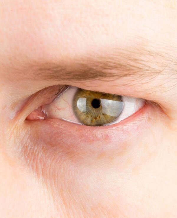 Ptosis surgery, drooping upper eyelid correction