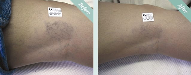 Sclerotherapy before and after 1
