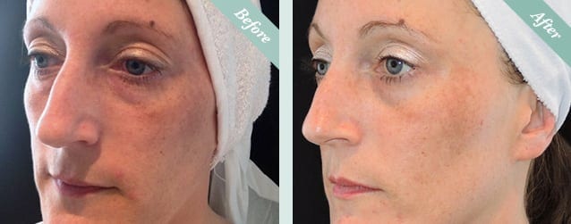 Lanluma before and after 1