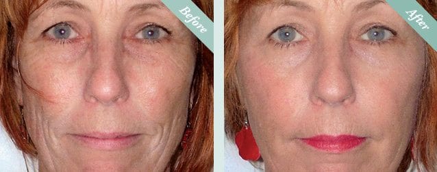 Lanluma before and after 2