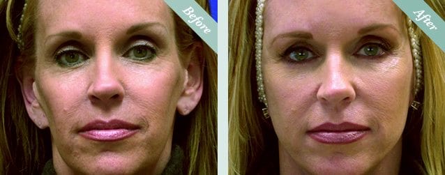Lanluma before and after 4
