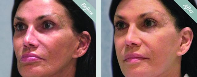 Lanluma before and after 8