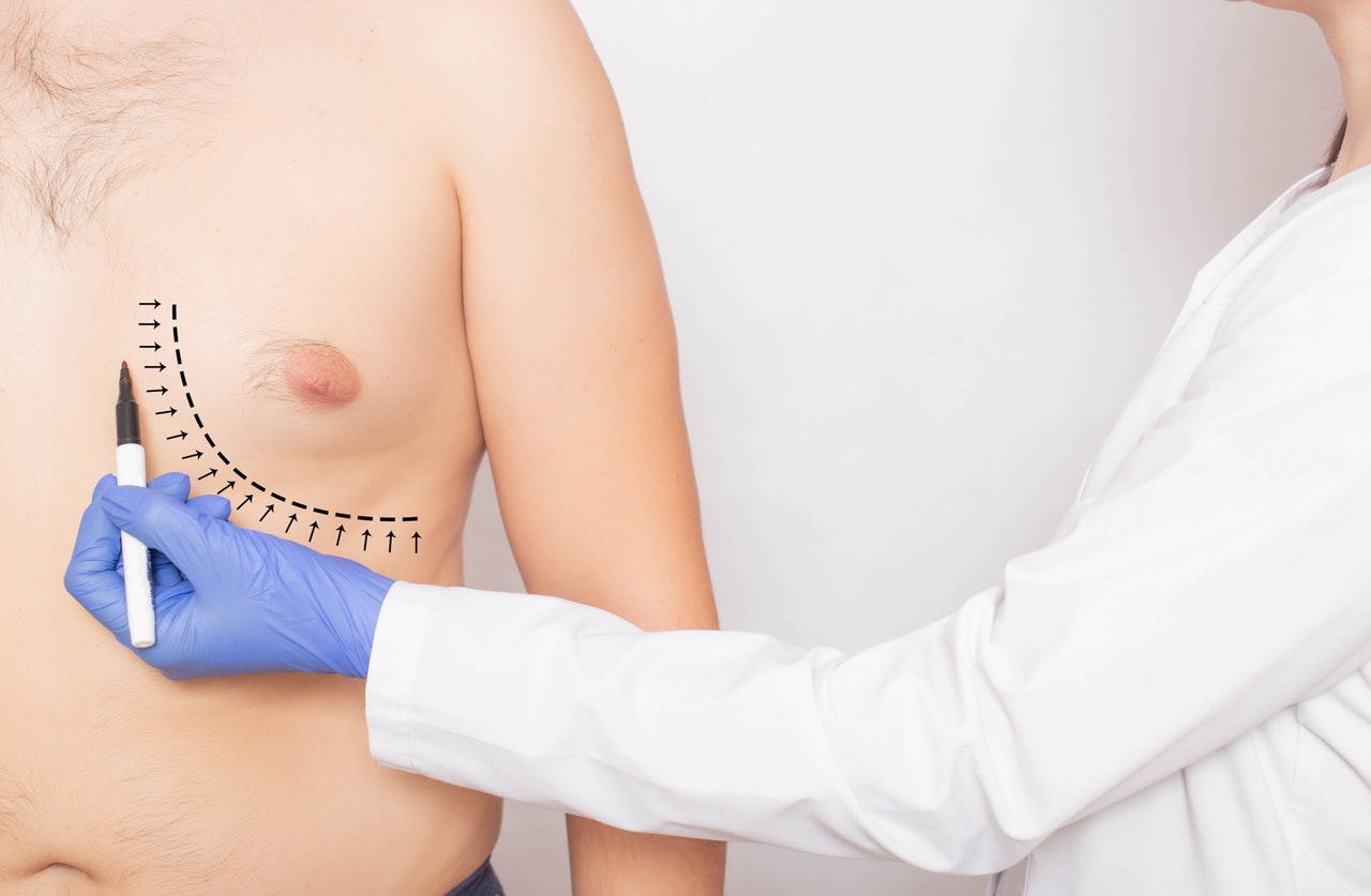 Gynaecomastia Surgery
