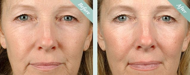 NEW Thermage FLX® Face before and after 1