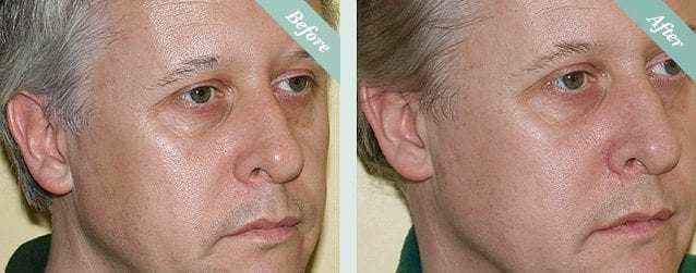 NEW Thermage FLX® Face before and after 2