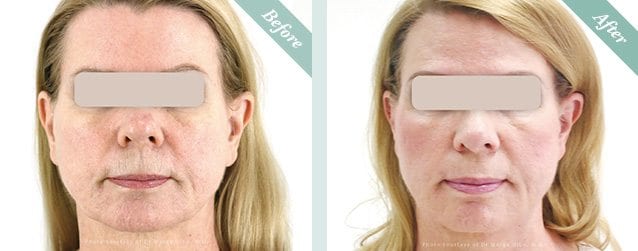 Ultracel HIFU Before & After 7